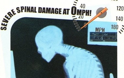 severe-spinal-damage